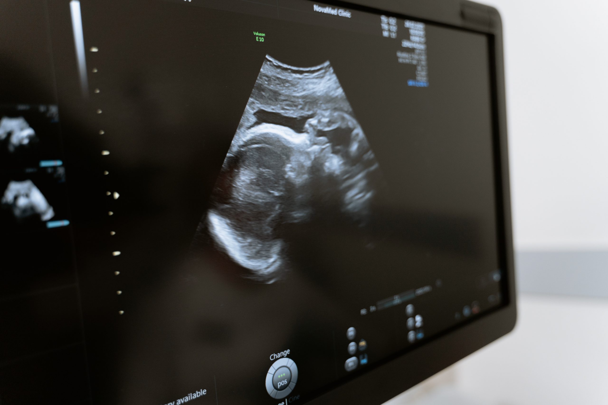 Texas Heartbeat Act Takes Effect Today, Abortion Lobby Looks to Supreme Court