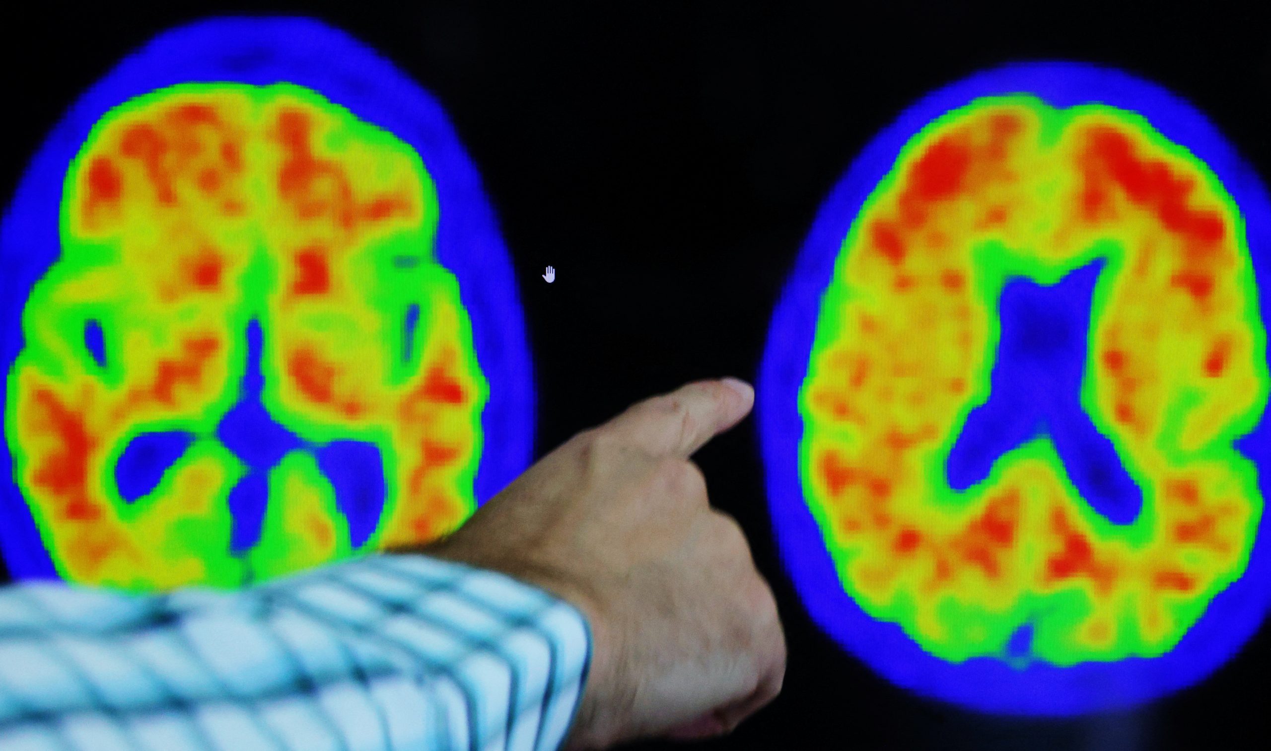 Lilly drug slows Alzheimer’s by 35%, bolstering treatment approach